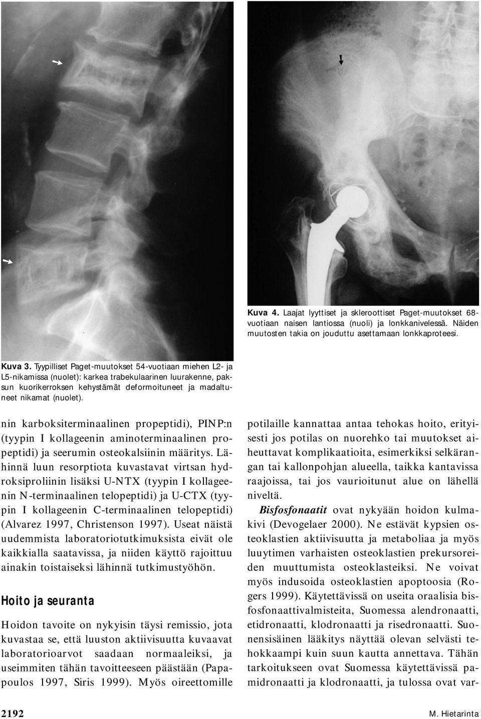 nin karboksiterminaalinen propeptidi), PINP:n (tyypin I kollageenin aminoterminaalinen propeptidi) ja seerumin osteokalsiinin määritys.