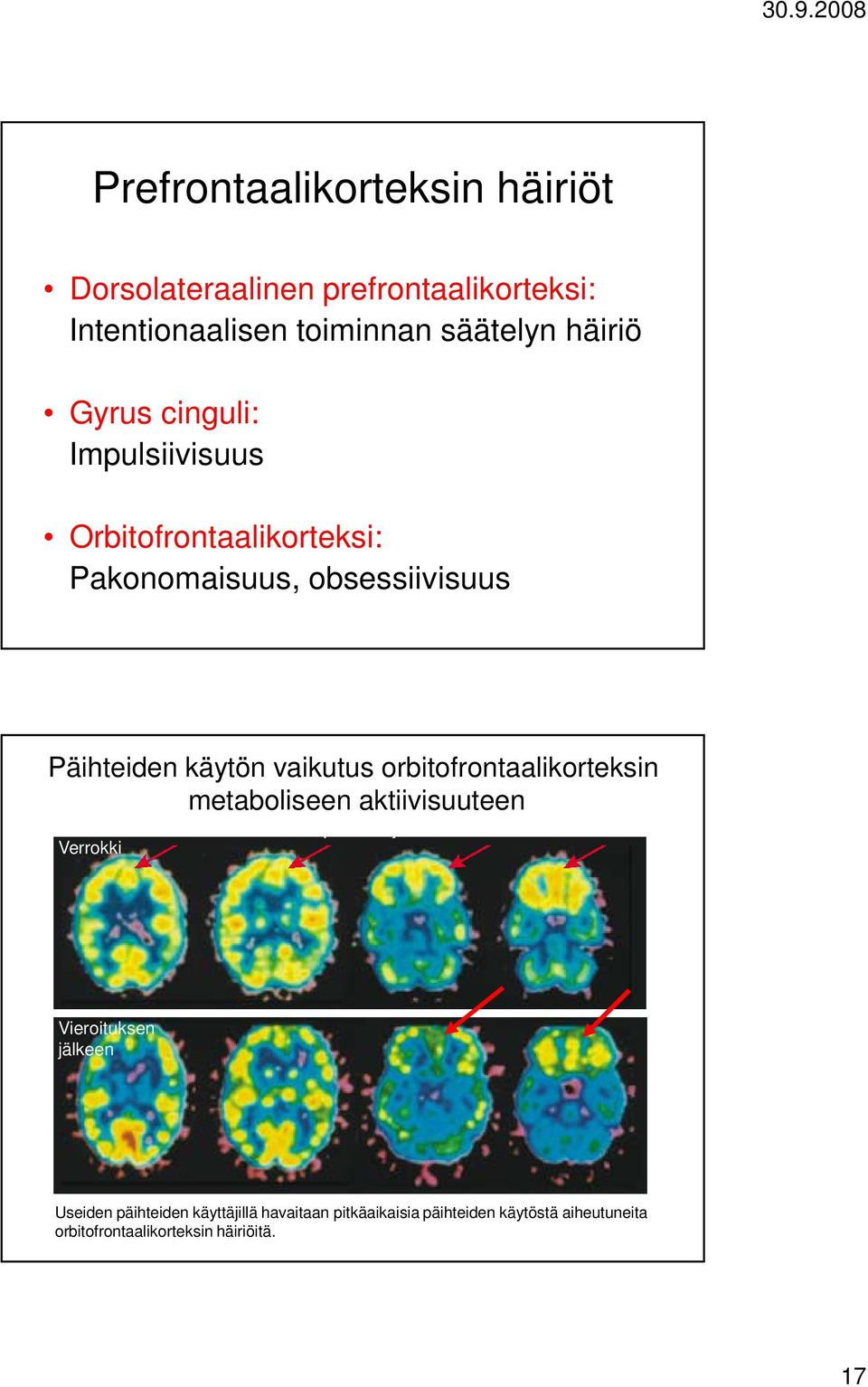 käytön vaikutus orbitofrontaalikorteksin metaboliseen aktiivisuuteen Verrokki Vieroituksen jälkeen Useiden