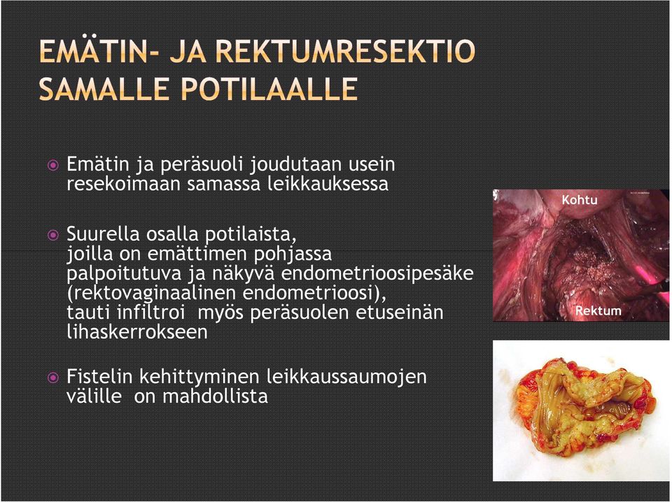 endometrioosipesäke (rektovaginaalinen endometrioosi), tauti infiltroi myös