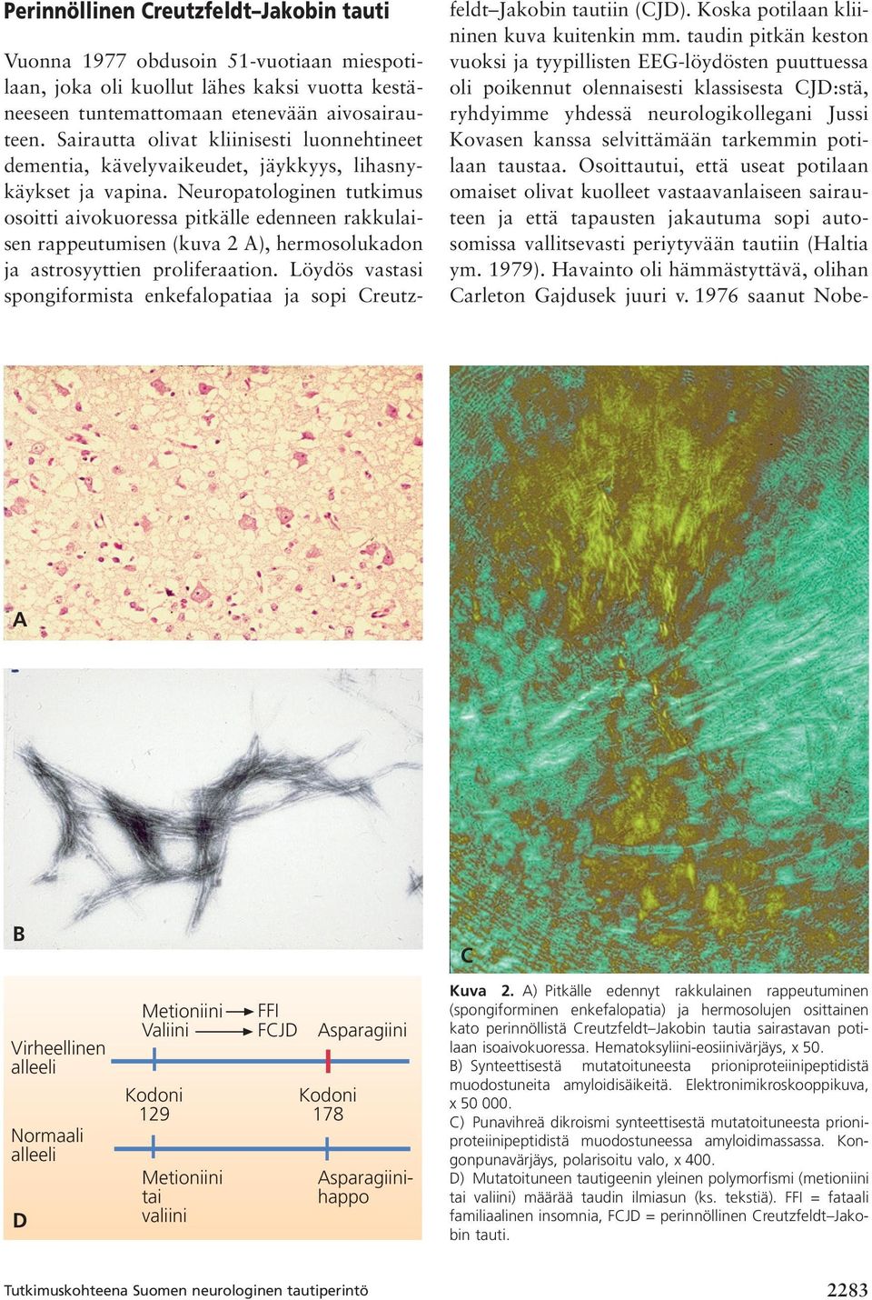 Neuropatologinen tutkimus osoitti aivokuoressa pitkälle edenneen rakkulaisen rappeutumisen (kuva 2 A), hermosolukadon ja astrosyyttien proliferaation.