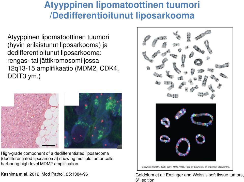 ) High-grade component of a dedifferentiated liposarcoma (dedifferentiated liposarcoma) showing multiple tumor cells harboring