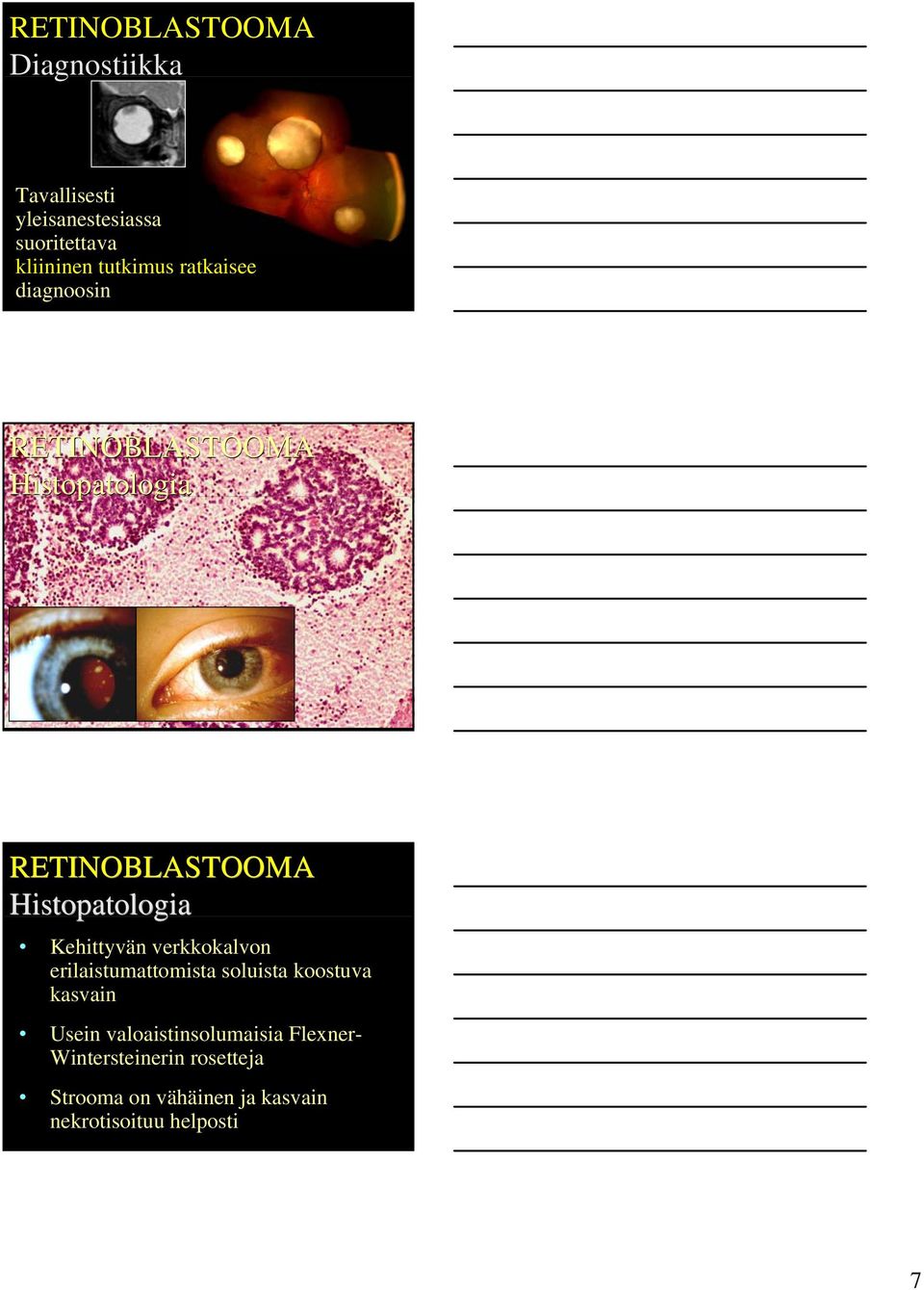 erilaistumattomista soluista koostuva kasvain Usein valoaistinsolumaisia