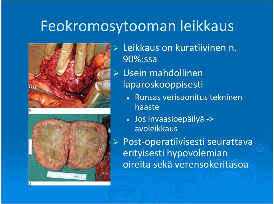 tekninen haaste Jos invaasioepäilyä -> avoleikkaus