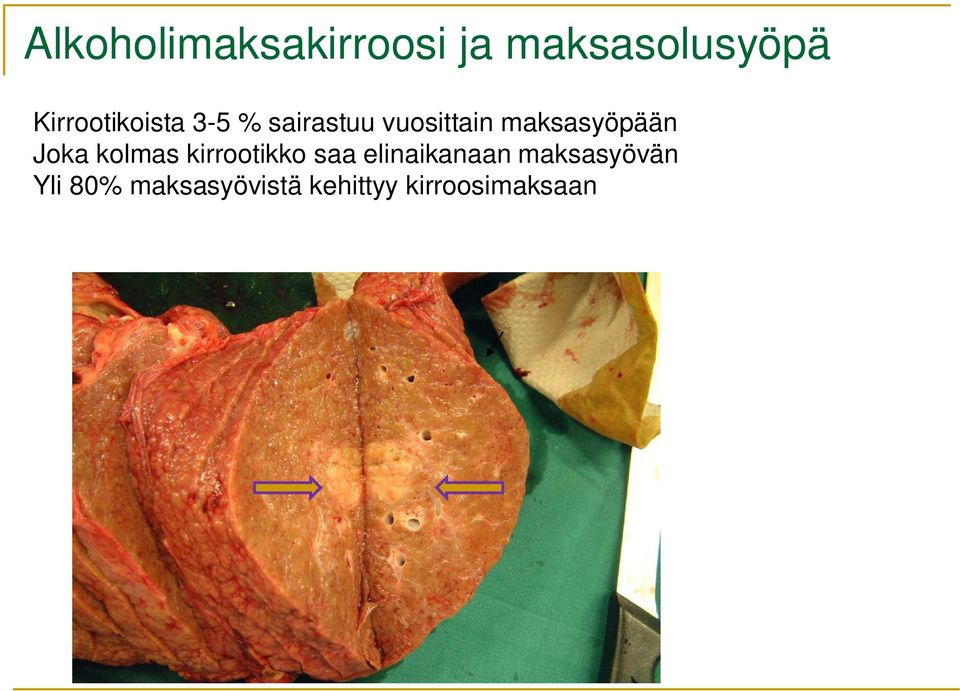 maksasyöpään Joka kolmas kirrootikko saa