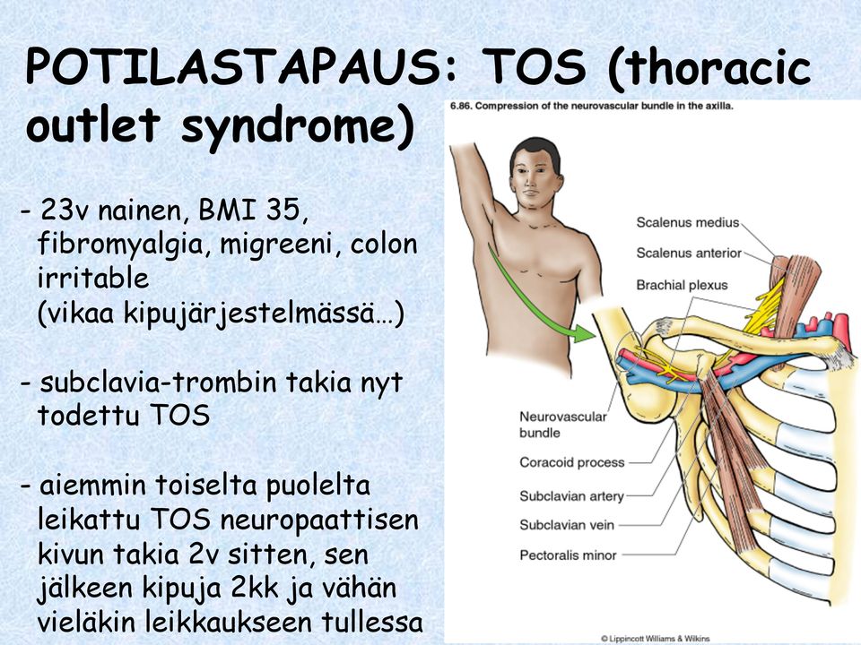 subclavia-trombin takia nyt todettu TOS - aiemmin toiselta puolelta leikattu