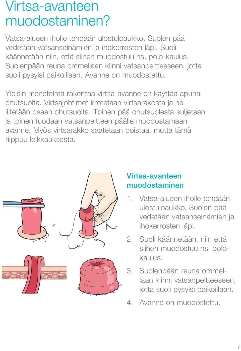 Virtsajohtimet irrotetaan virtsarakosta ja ne liitetään osaan ohutsuolta. Toinen pää ohutsuolesta suljetaan ja toinen tuodaan vatsanpeitteen päälle muodostamaan avanne.
