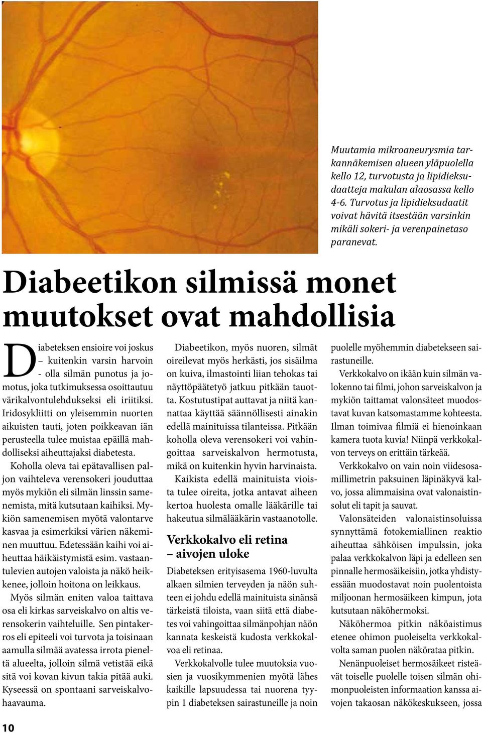 Koholla oleva tai epätavallisen paljon vaihteleva verensokeri jouduttaa myös mykiön eli silmän linssin samenemista, mitä kutsutaan kaihiksi.