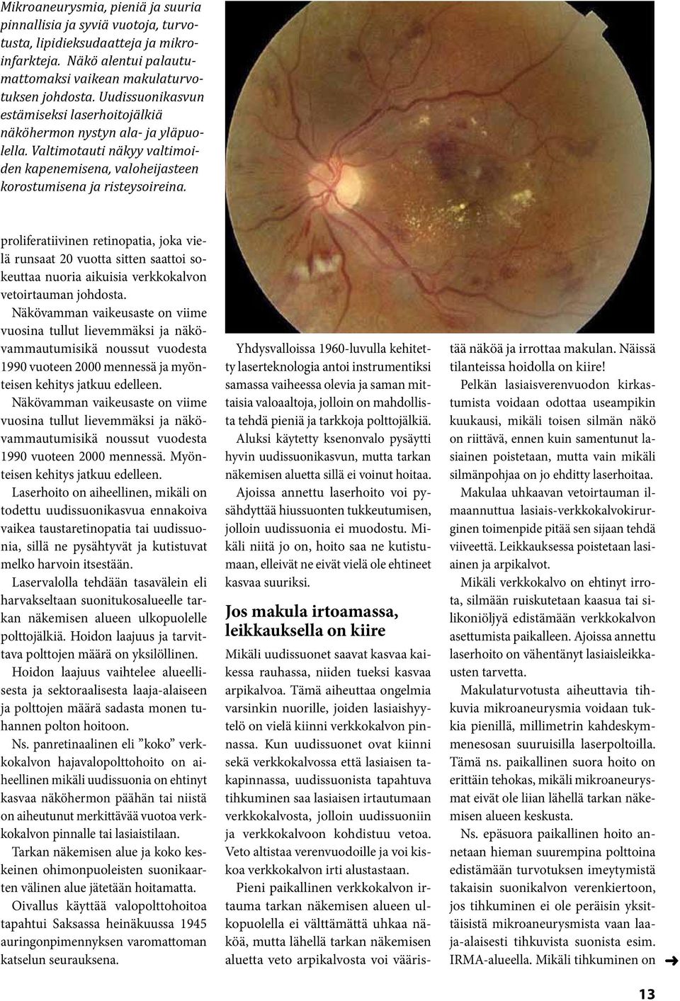 proliferatiivinen retinopatia, joka vielä runsaat 20 vuotta sitten saattoi sokeuttaa nuoria aikuisia verkkokalvon vetoirtauman johdosta.