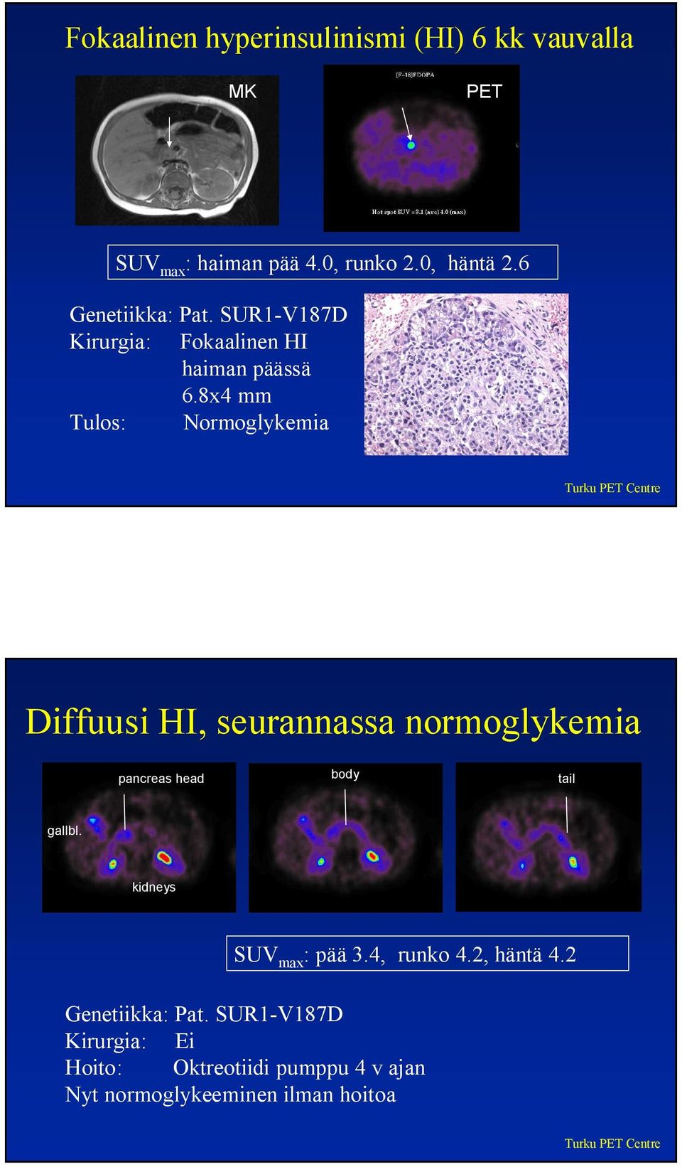 8x4 mm Tulos: Normoglykemia Diffuusi HI, seurannassa normoglykemia pancreas head body tail gallbl.