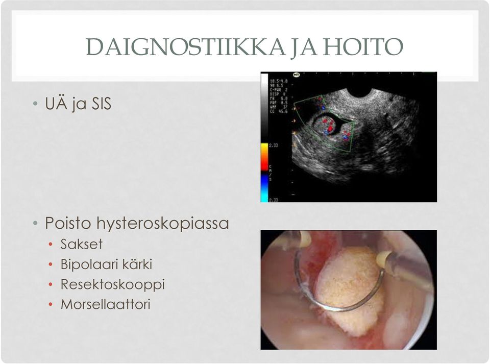 hysteroskopiassa Sakset