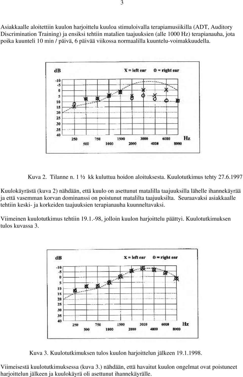 päivää viikossa normaalilla kuuntelu-voimakkuudella. Kuva 2. Tilanne n. 1 ½ kk kuluttua hoidon aloituksesta. Kuulotutkimus tehty 27.6.