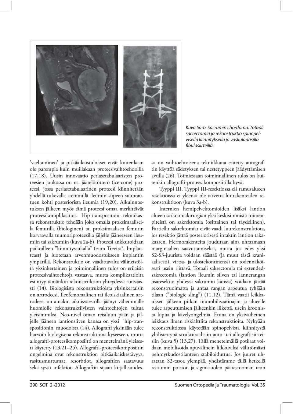 jäätelötötterö (ice-cone) proteesi, jossa periasetabulaarinen proteesi kiinnitetään yhdellä tukevalla stemmillä ileumin siipeen suuntautuen kohti posteriorista ileumia (19,20).