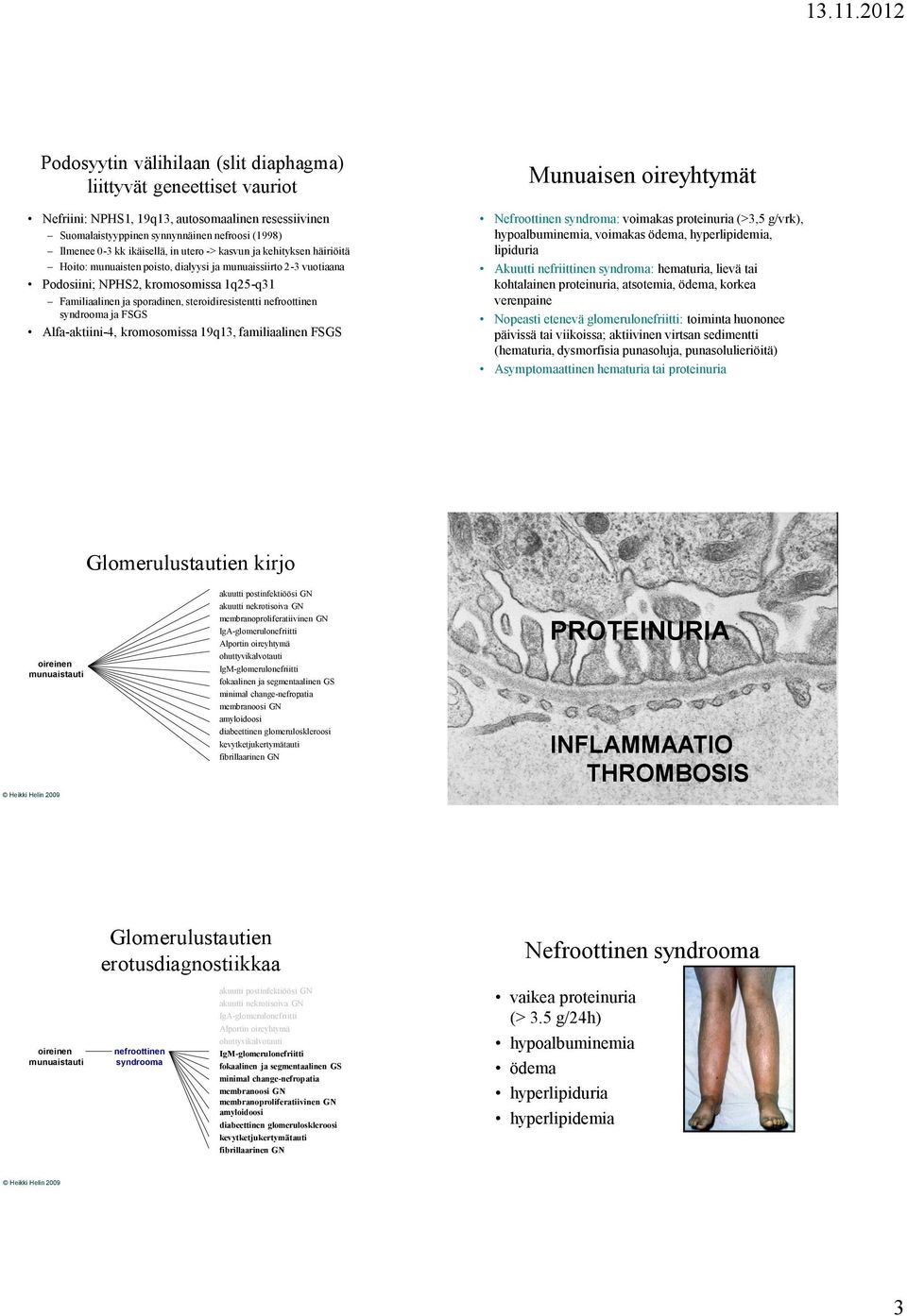 steroidiresistentti nefroottinen syndrooma ja FSGS Alfa-aktiini-4, kromosomissa 19q13, familiaalinen FSGS Nefroottinen syndroma: voimakas proteinuria (>3,5 g/vrk), hypoalbuminemia, voimakas ödema,