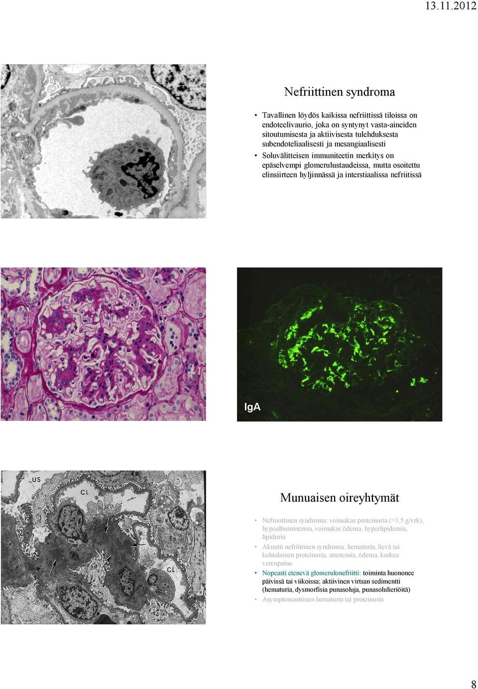 Nefroottinen syndroma: voimakas proteinuria (>3,5 g/vrk), hypoalbuminemia, voimakas ödema, hyperlipidemia, lipiduria Akuutti nefriittinen syndroma: hematuria, lievä tai kohtalainen proteinuria,