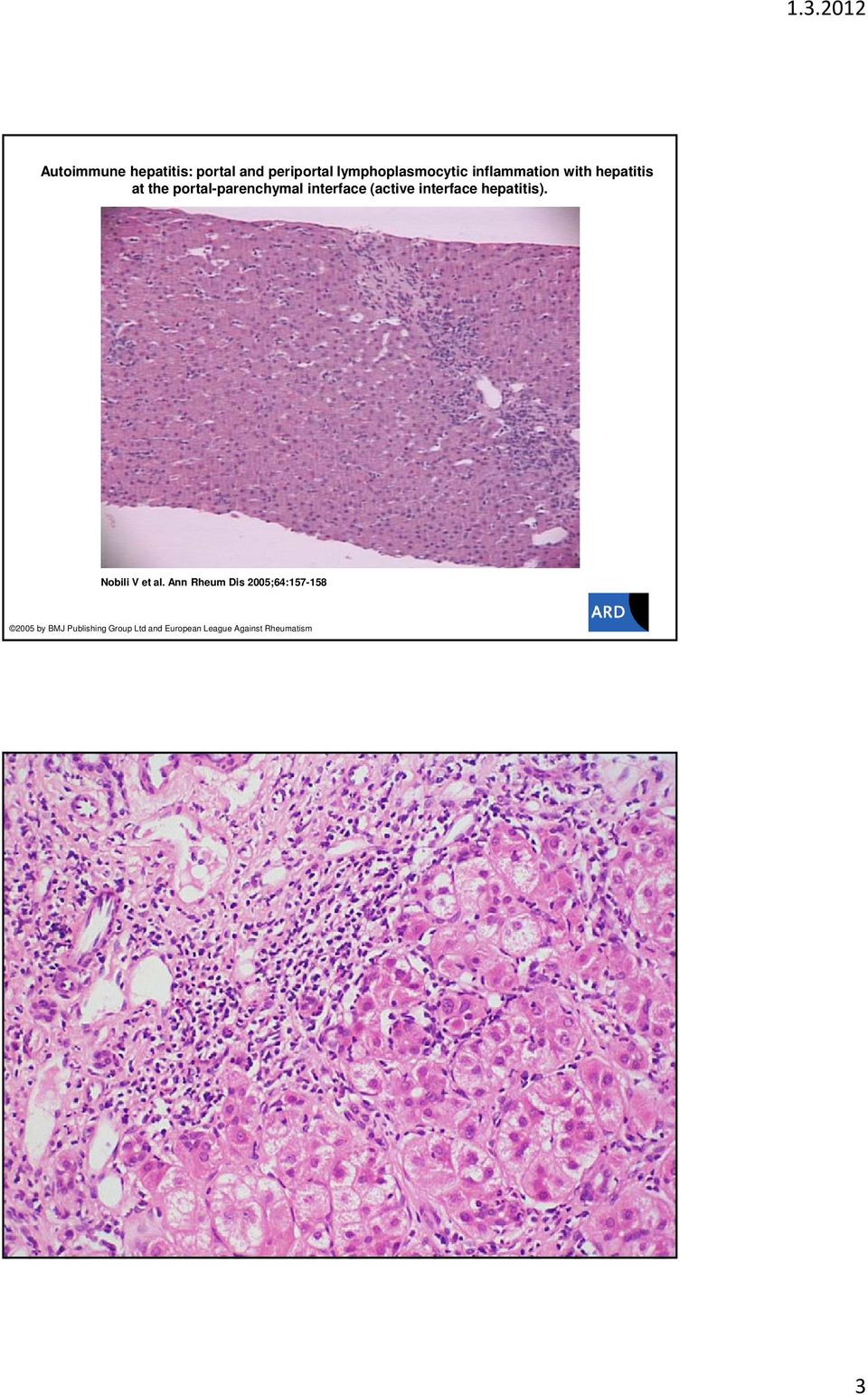 (active interface hepatitis). Nobili V et al.