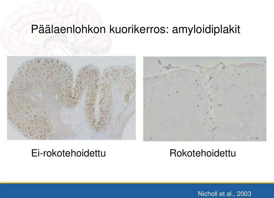 amyloidiplakit