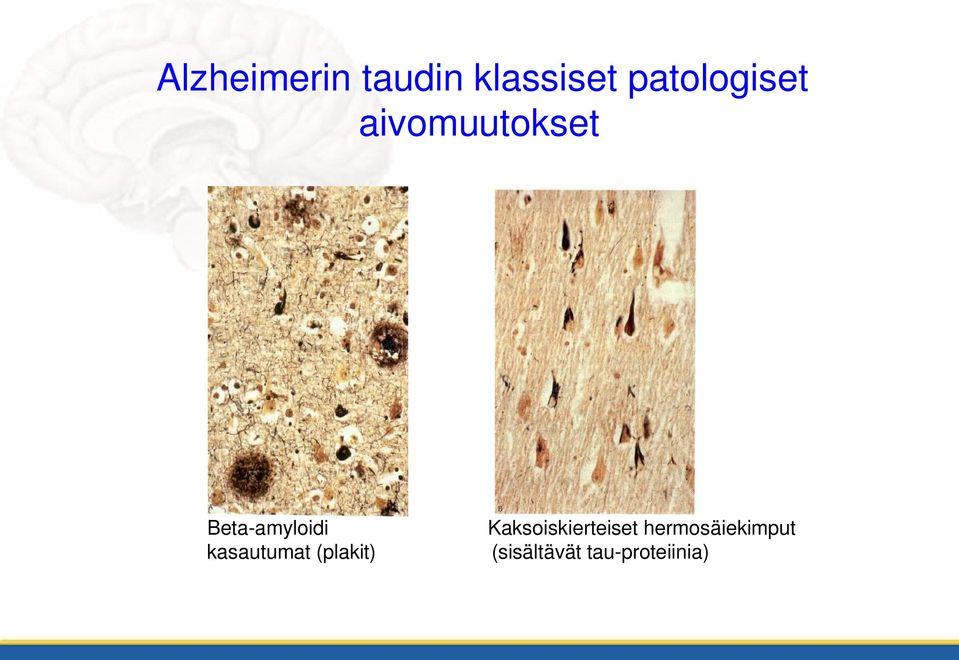 Beta-amyloidi kasautumat (plakit)