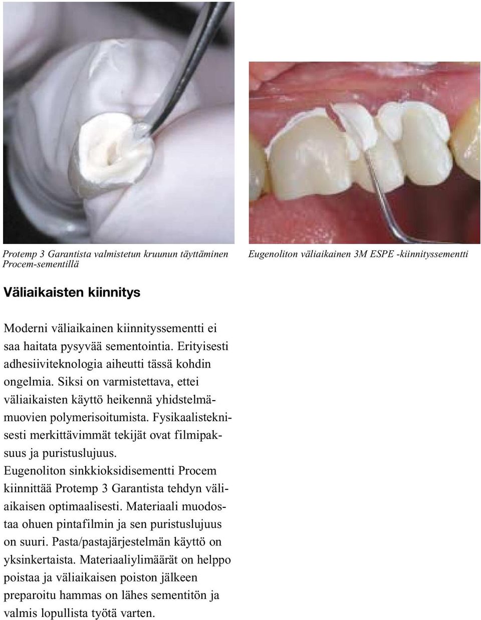 Fysikaalisteknisesti merkittävimmät tekijät ovat filmipaksuus ja puristuslujuus. Eugenoliton sinkkioksidisementti Procem kiinnittää Protemp 3 Garantista tehdyn väliaikaisen optimaalisesti.