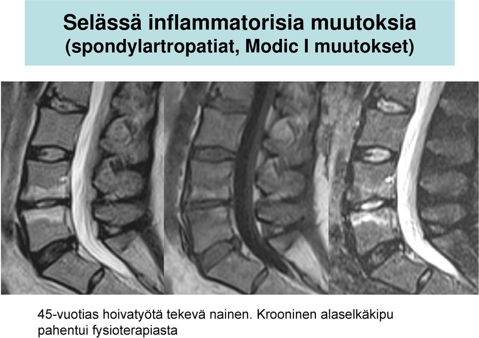 45-vuotias hoivatyötä tekevä nainen.