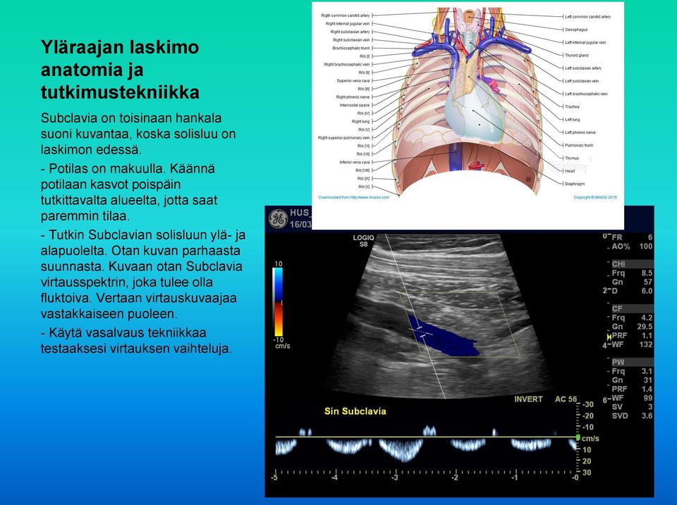- Tutkin Subclavian solisluun ylä- ja alapuolelta. Otan kuvan parhaasta suunnasta.