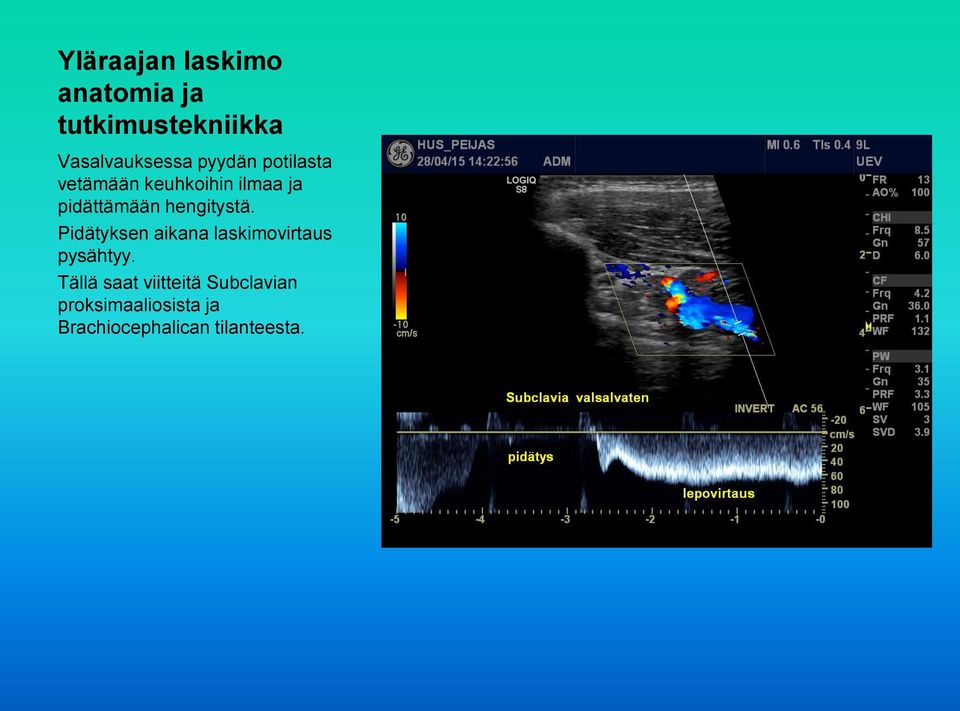 Pidätyksen aikana laskimovirtaus pysähtyy.