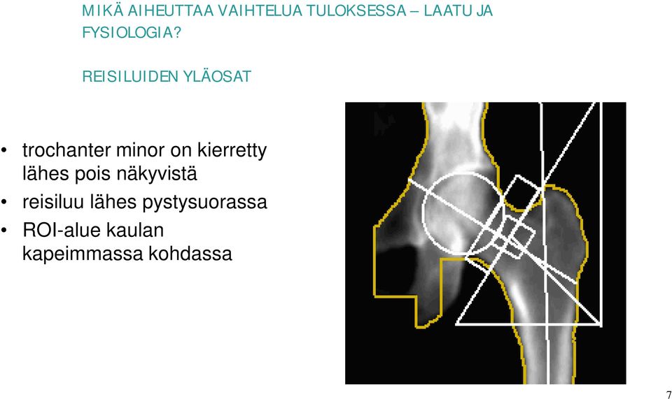 REISILUIDEN YLÄOSAT trochanter minor on