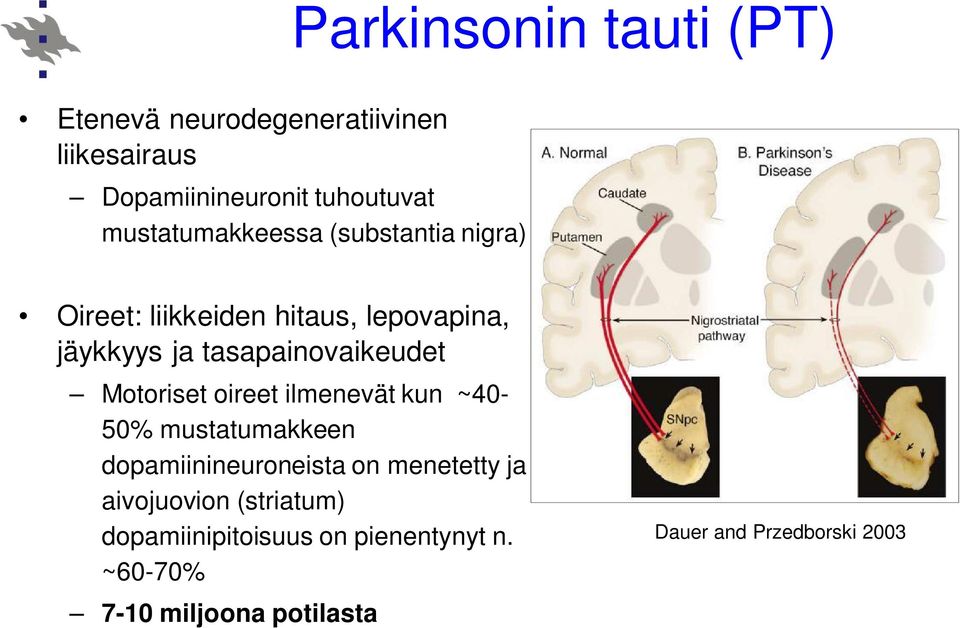 tasapainovaikeudet Motoriset oireet ilmenevät kun ~40-50% mustatumakkeen dopamiinineuroneista on