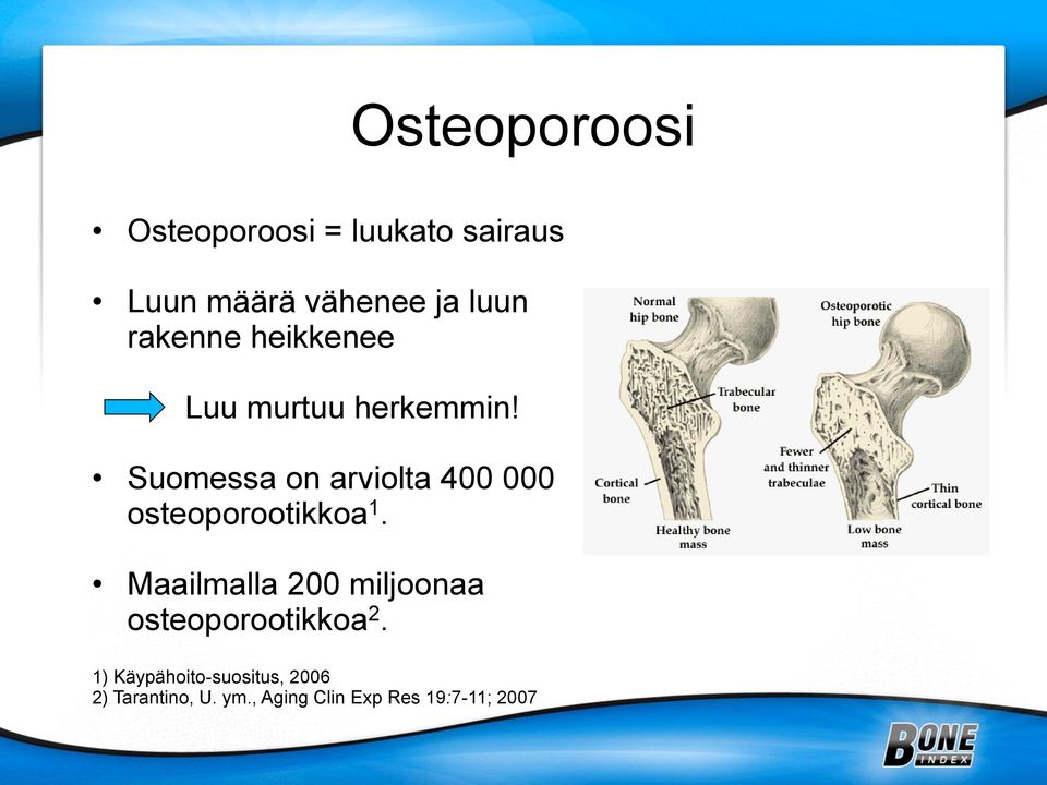 Suomessa on arviolta 400 000 osteoporootikkoa 1.