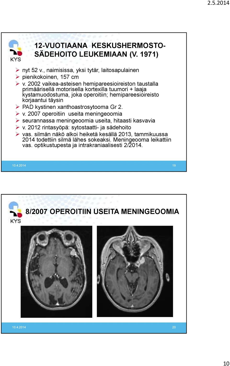 kystinen xanthoastrosytooma Gr 2. v. 2007 operoitiin useita meningeoomia seurannassa meningeoomia useita, hitaasti kasvavia v. 2012 rintasyöpä: sytostaatti- ja sädehoito vas.
