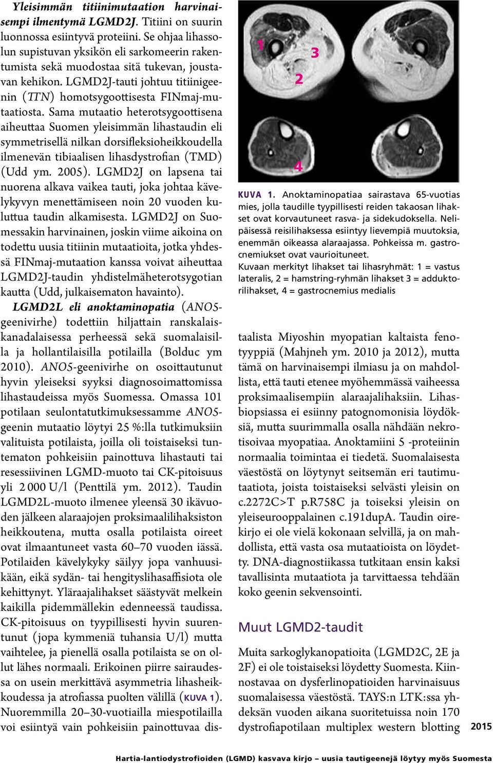 Kuvaan merkityt lihakset tai lihasryhmät: 1 = vastus lateralis, 2 = hamstring-ryhmän lihakset 3 = adduktorilihakset, 4 = gastrocnemius medialis Yleisimmän titiinimutaation harvinaisempi ilmentymä