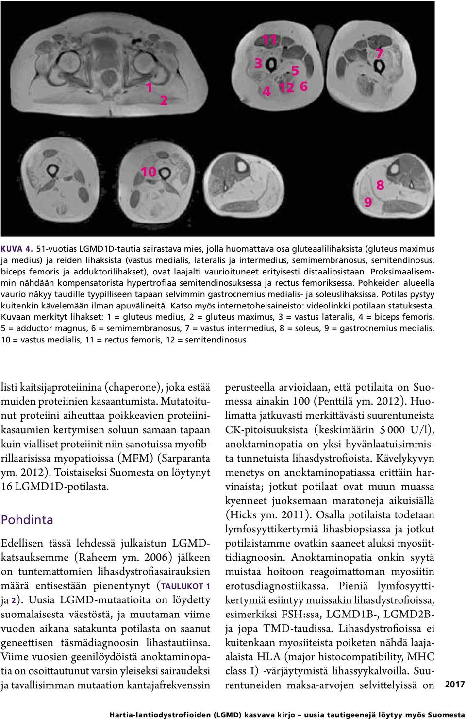 semitendinosus, biceps femoris ja adduktorilihakset), ovat laajalti vaurioituneet erityisesti distaaliosistaan.