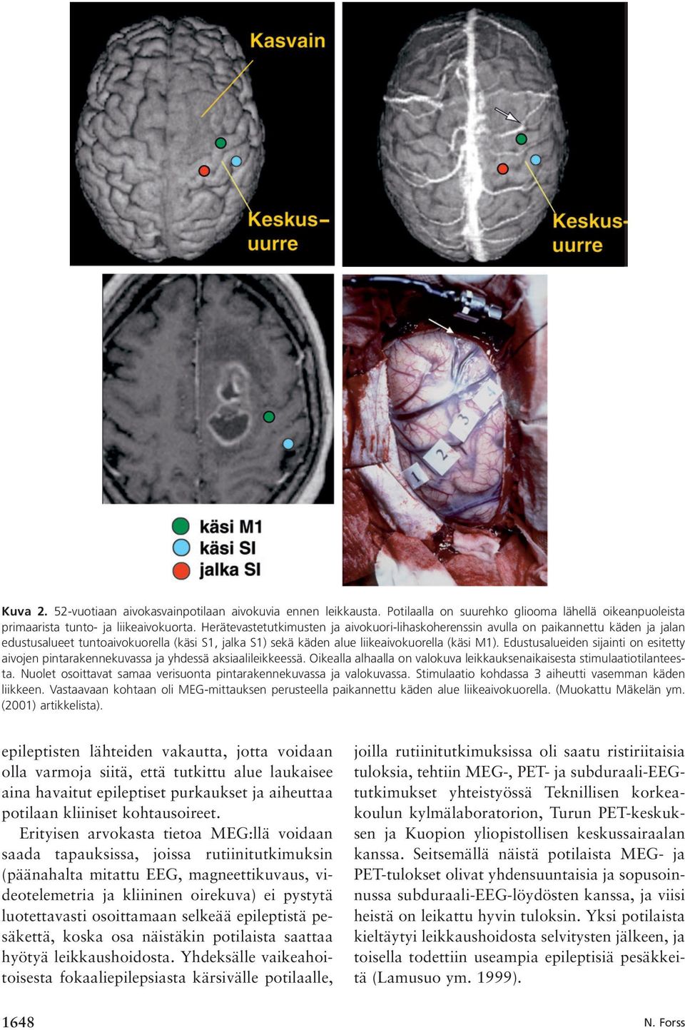 Edustusalueiden sijainti on esitetty aivojen pintarakennekuvassa ja yhdessä aksiaalileikkeessä. Oikealla alhaalla on valokuva leikkauksenaikaisesta stimulaatiotilanteesta.
