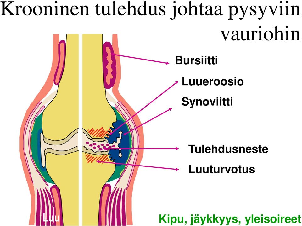 Synoviitti Tulehdusneste Luuturvotus