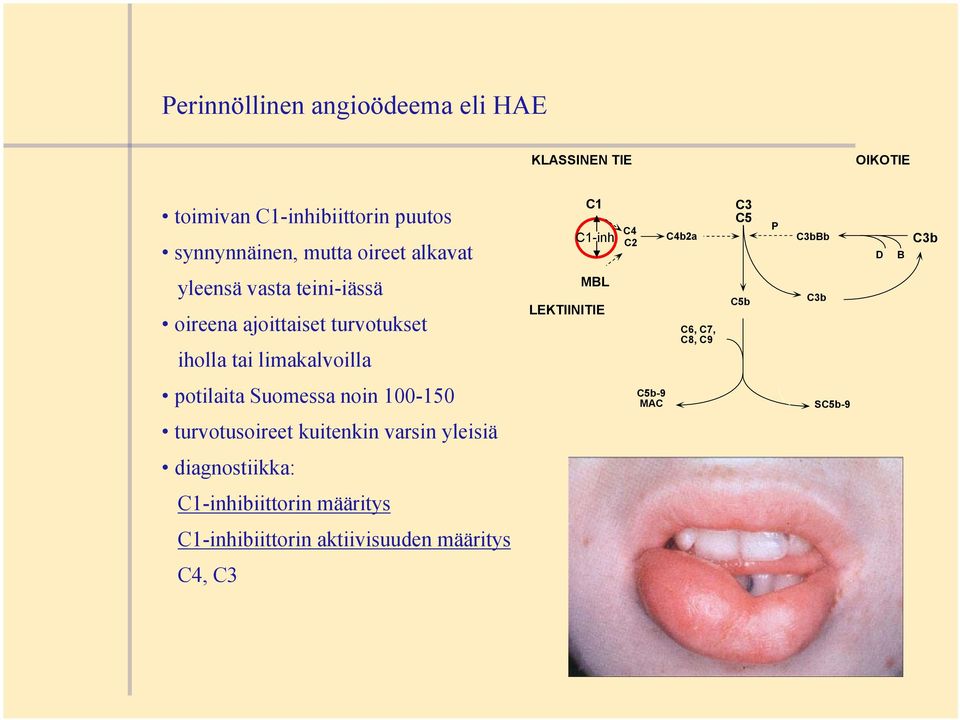 iholla tai limakalvoilla MBL LEKTIINITIE C6, C7, C8, C9 C5b potilaita Suomessa noin 100-150 C5b-9 MAC SC5b-9