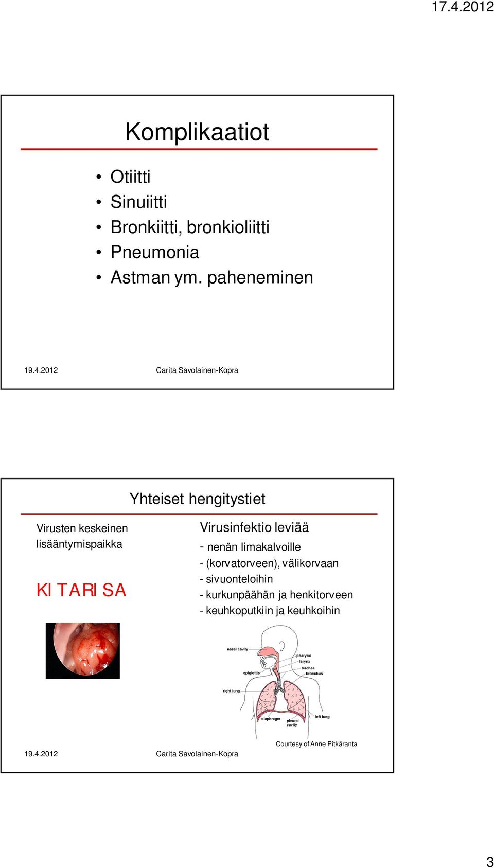 Virusinfektio leviää - nenän limakalvoille - (korvatorveen), välikorvaan -