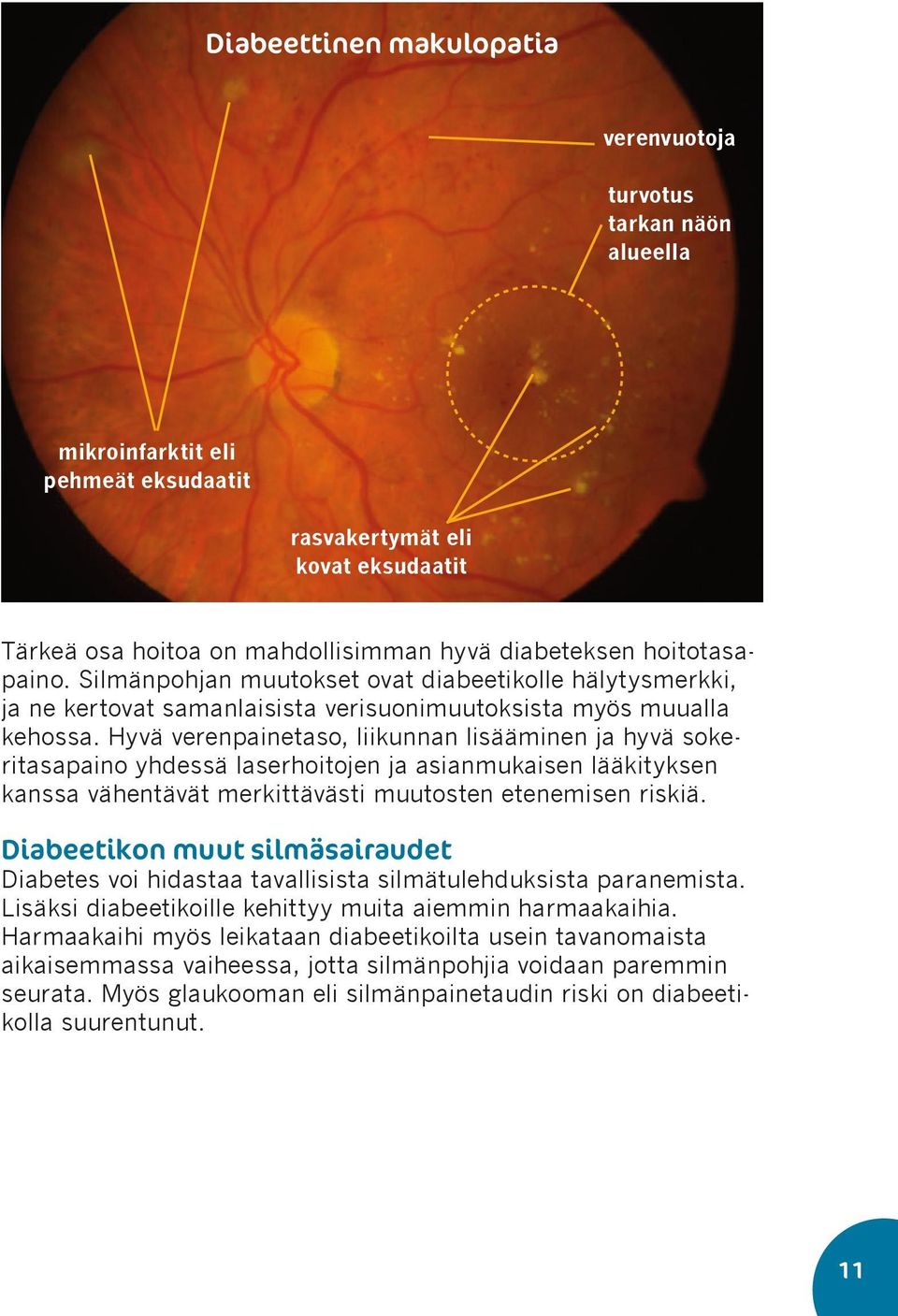 Hyvä verenpainetaso, liikunnan lisääminen ja hyvä sokeritasapaino yhdessä laserhoitojen ja asianmukaisen lääkityksen kanssa vähentävät merkittävästi muutosten etenemisen riskiä.