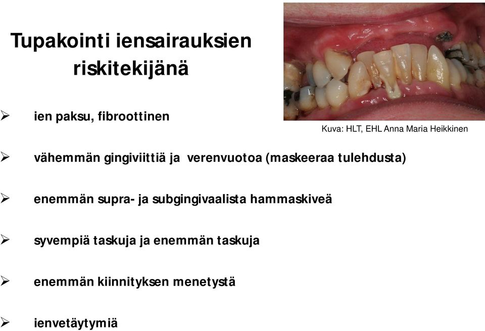 (maskeeraa tulehdusta) enemmän supra- ja subgingivaalista hammaskiveä
