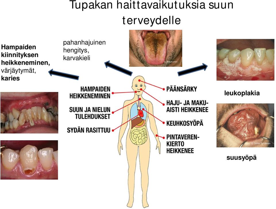 heikkeneminen, värjäytymät, karies