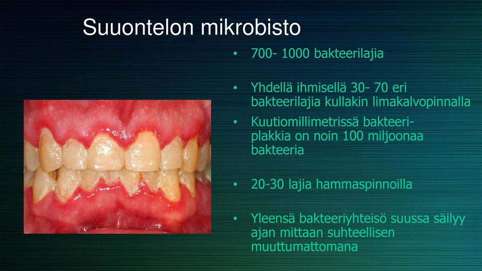 bakteeriplakkia on noin 100 miljoonaa bakteeria 20-30 lajia