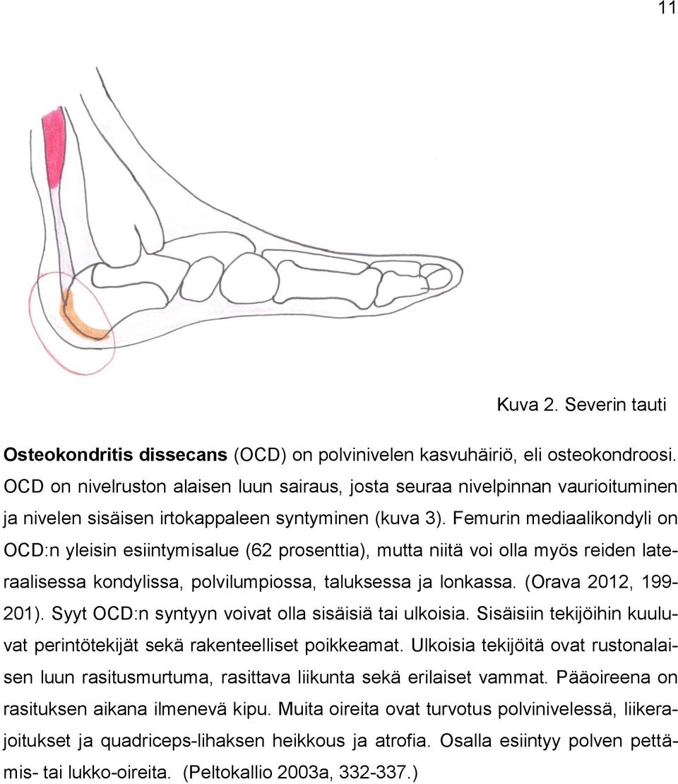 Femurin mediaalikondyli on OCD:n yleisin esiintymisalue (62 prosenttia), mutta niitä voi olla myös reiden lateraalisessa kondylissa, polvilumpiossa, taluksessa ja lonkassa. (Orava 2012, 199-201).