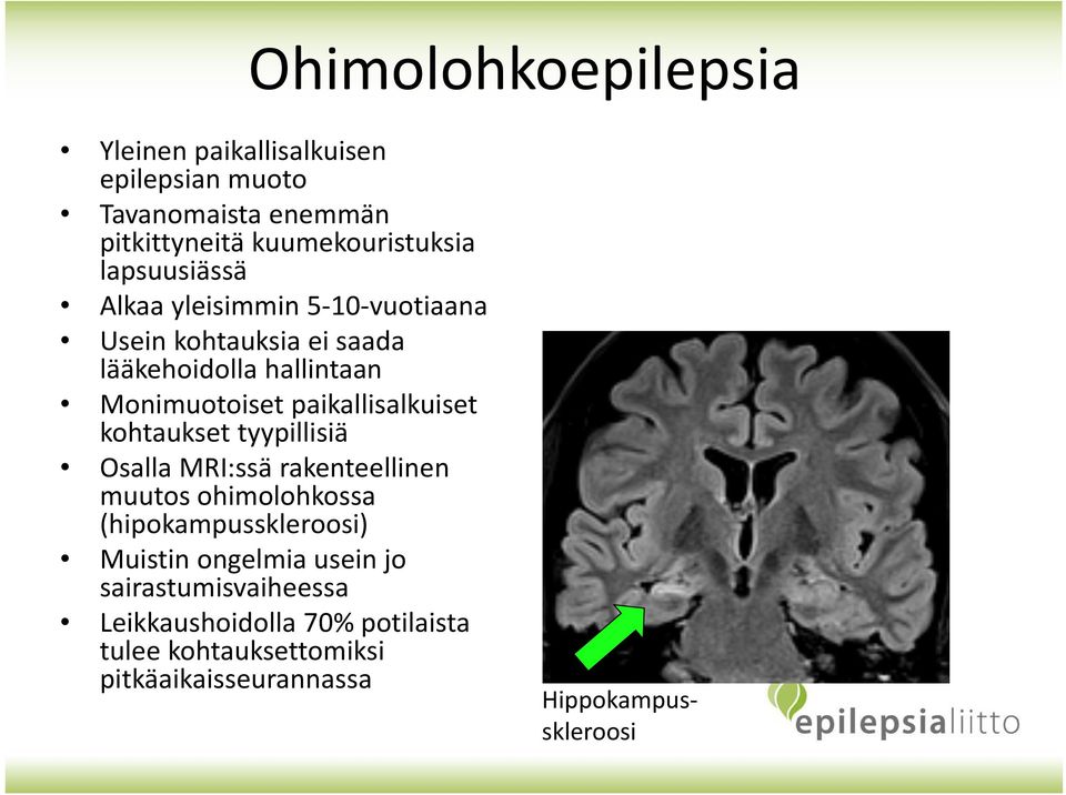 paikallisalkuiset kohtaukset tyypillisiä Osalla MRI:ssä rakenteellinen muutos ohimolohkossa (hipokampusskleroosi) Muistin