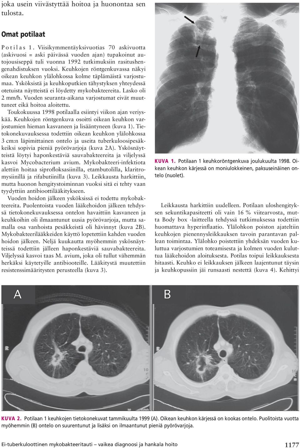 Keuhkojen röntgenkuvassa näkyi oikean keuhkon ylälohkossa kolme täplämäistä varjostumaa. Ysköksistä ja keuhkoputkien tähystyksen yhteydessä otetuista näytteistä ei löydetty mykobakteereita.