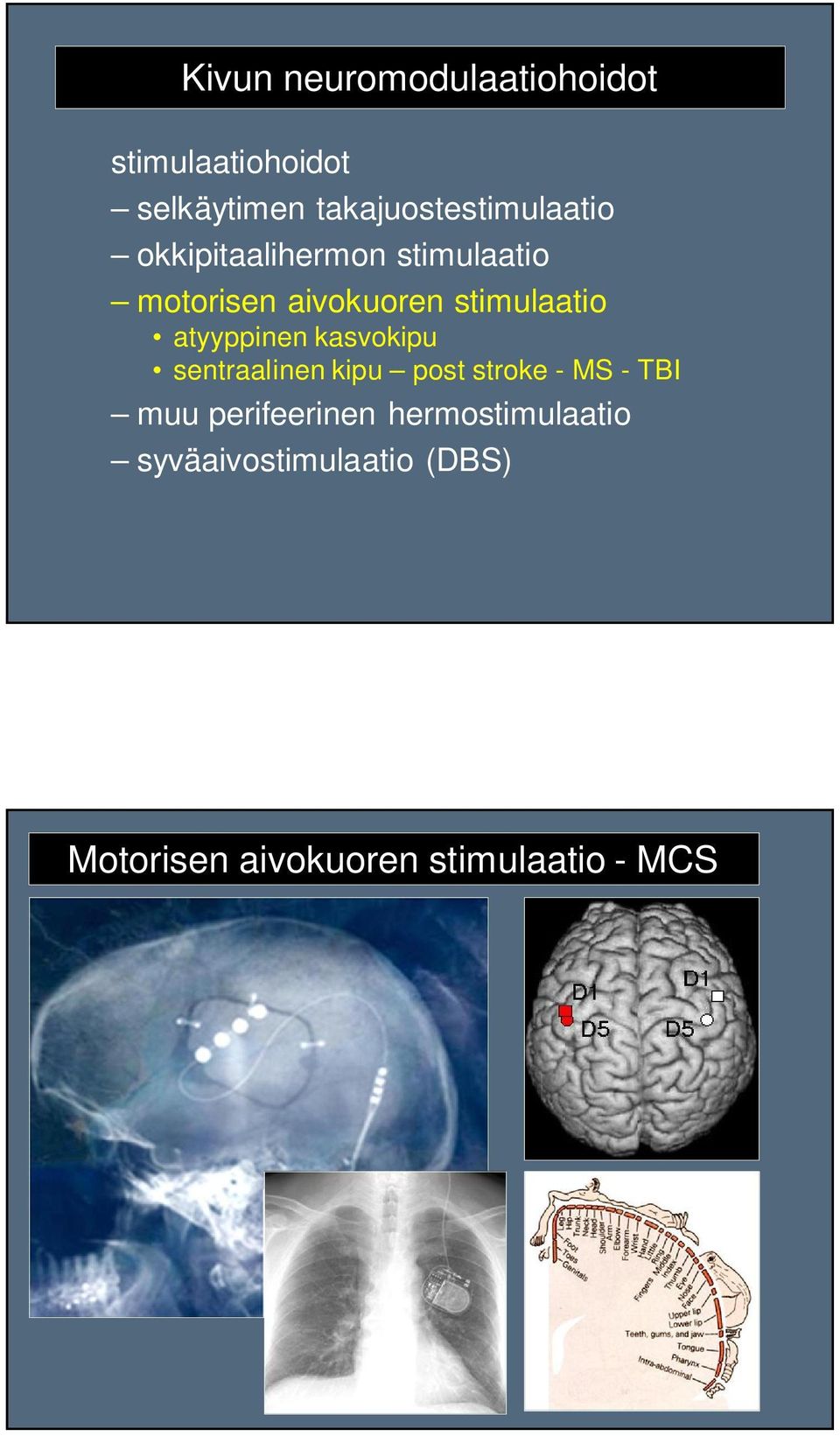 stimulaatio atyyppinen kasvokipu sentraalinen kipu post stroke - MS - TBI