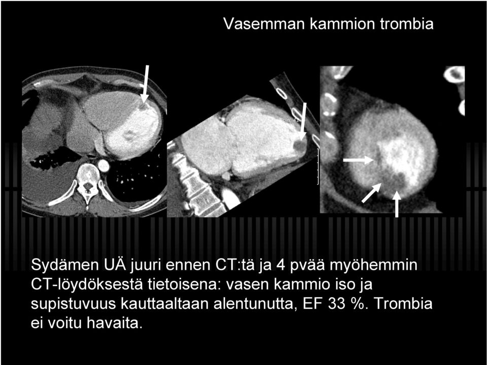 tietoisena: vasen kammio iso ja supistuvuus