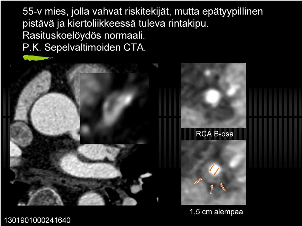 rintakipu. Rasituskoelöydös normaali. P.K.