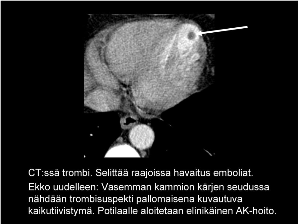 nähdään trombisuspekti pallomaisena kuvautuva