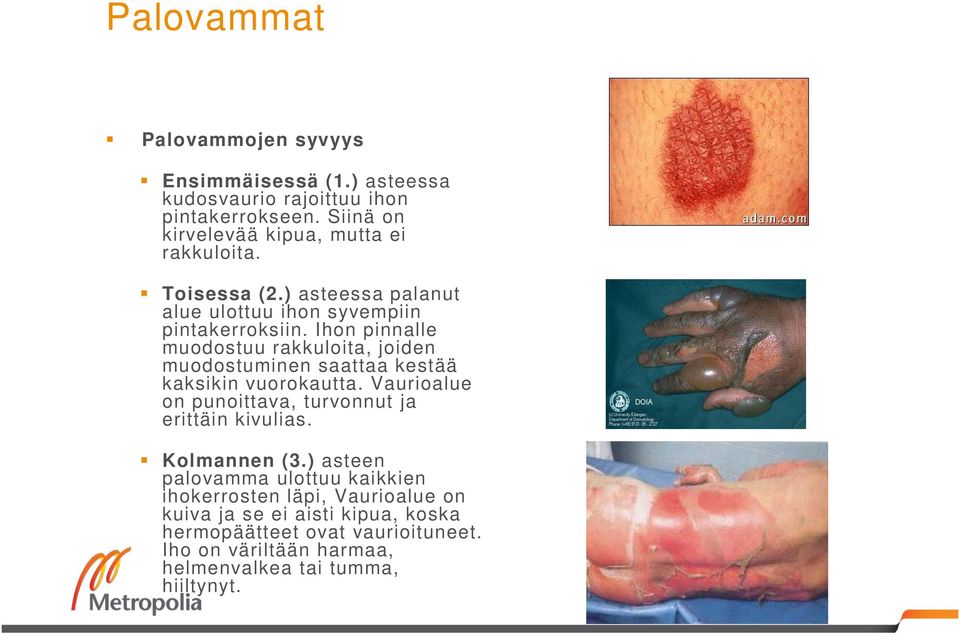 Ihon pinnalle muodostuu rakkuloita, joiden muodostuminen saattaa kestää kaksikin vuorokautta.