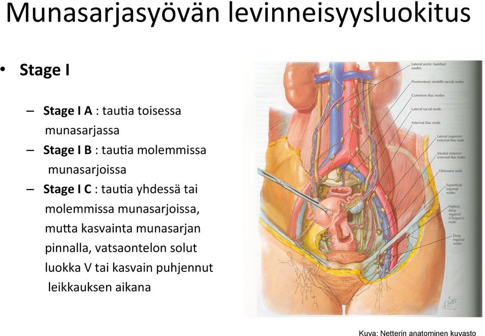 yhdessä tai molemmissa munasarjoissa, muqa kasvainta munasarjan pinnalla,