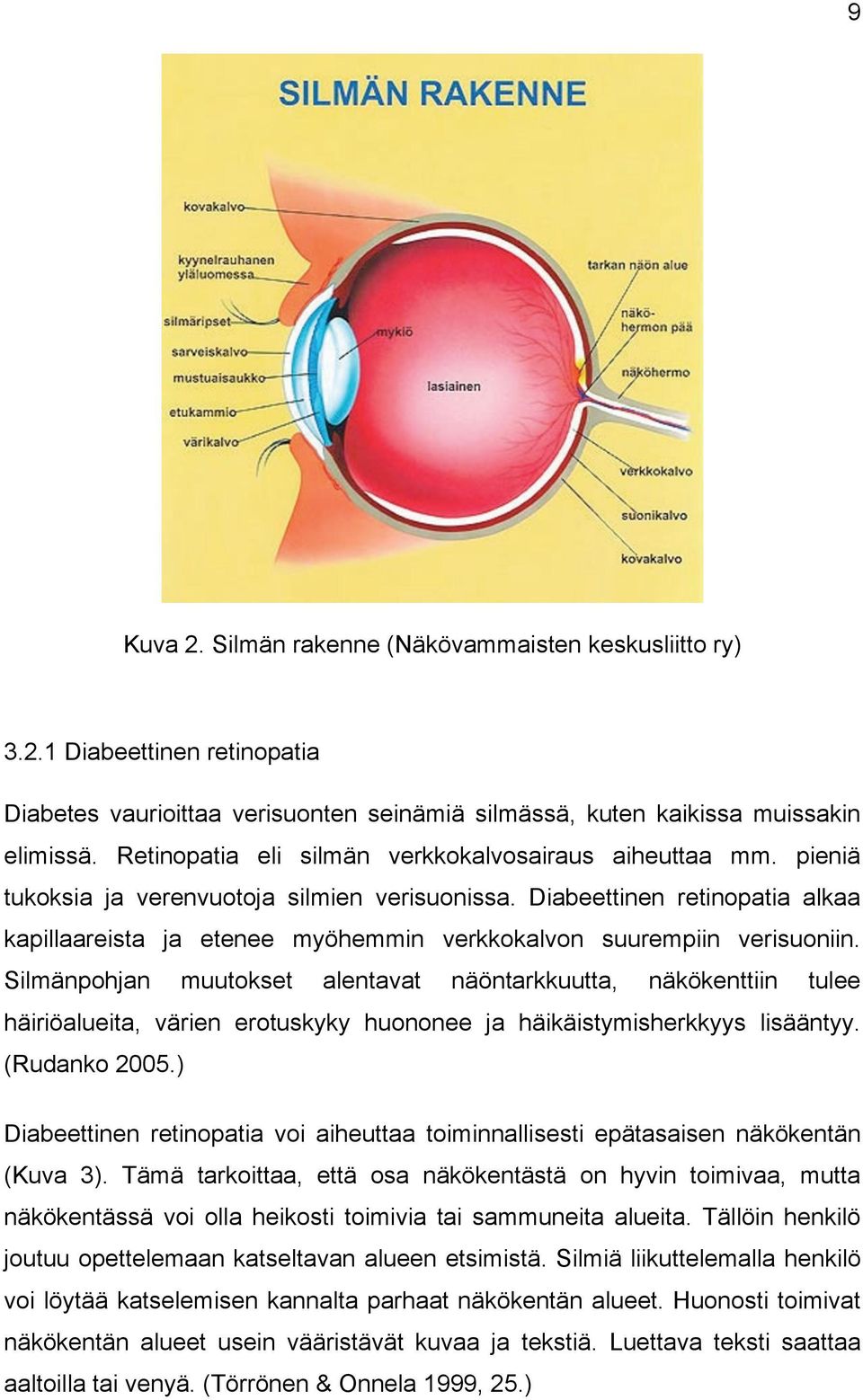 Diabeettinen retinopatia alkaa kapillaareista ja etenee myöhemmin verkkokalvon suurempiin verisuoniin.