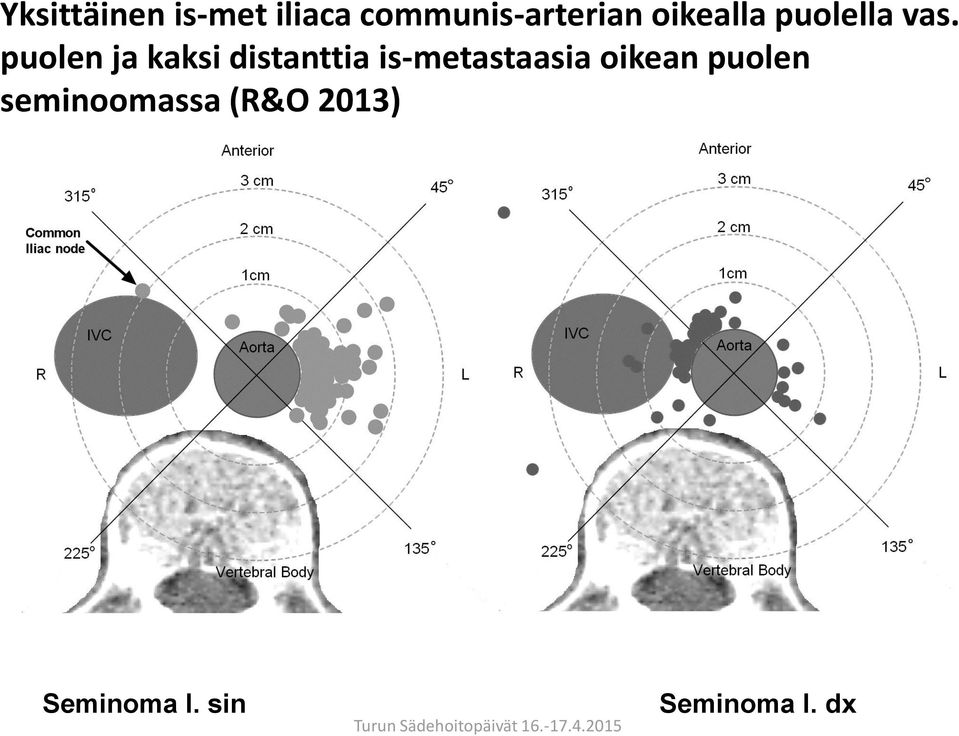 puolen ja kaksi distanttia is-metastaasia